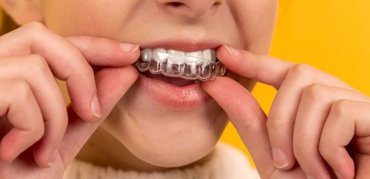 Persona colocando un alineador transparente sobre sus dientes