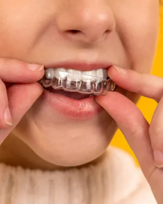 Persona colocando un alineador transparente sobre sus dientes