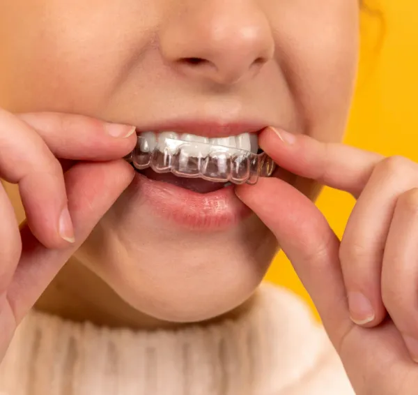 Persona colocando un alineador transparente sobre sus dientes